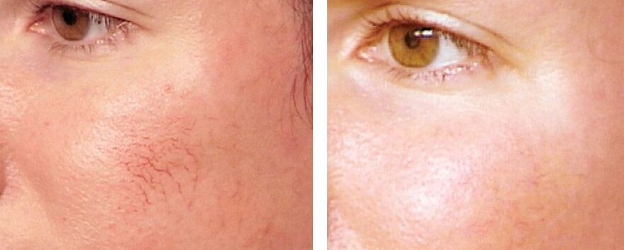 Distanza da Rosacea