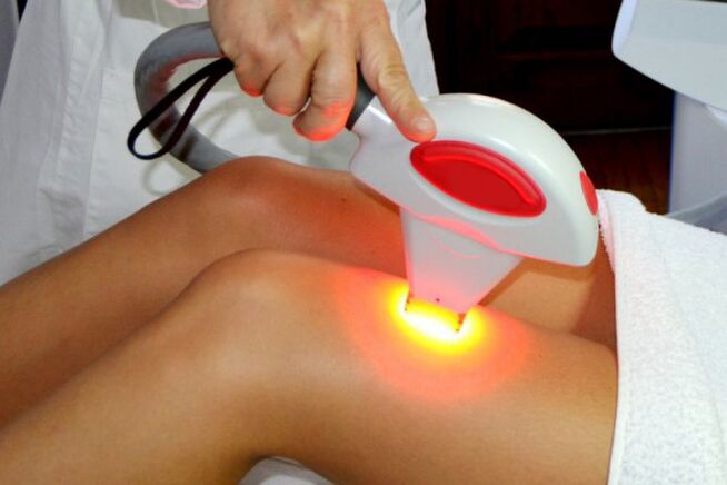 Depilazione per capelli laser