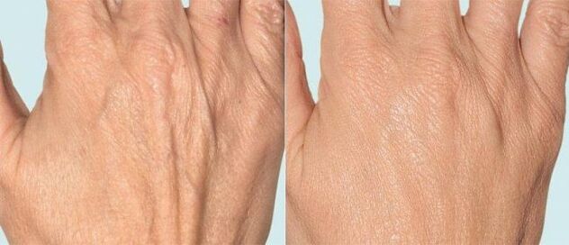 Pelle delle mani prima e dopo la terapia frazionata