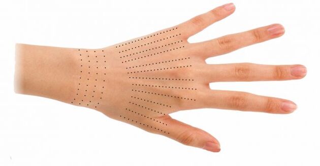 Siti di iniezione per le mani durante la biorivitalizzazione