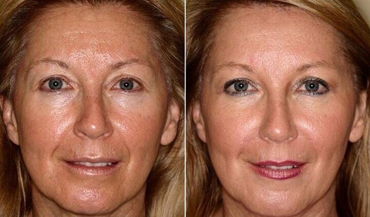 prima e dopo il ringiovanimento della pelle del viso a casa