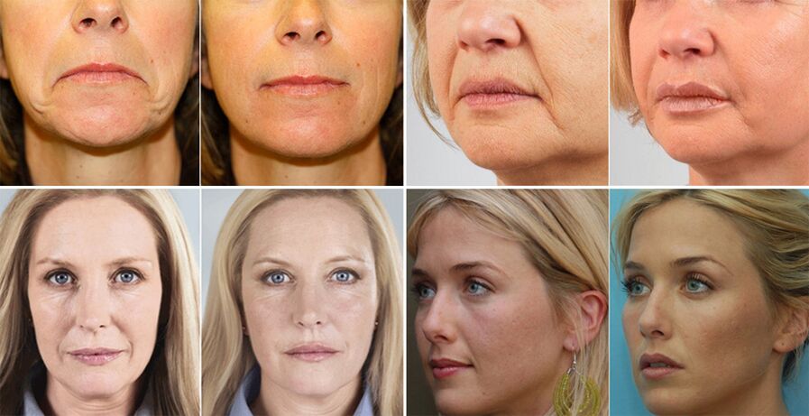 Foto di donne prima e dopo il ringiovanimento della pelle del viso